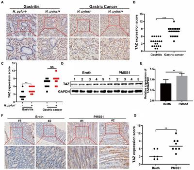 A positive feedback loop of the TAZ/β-catenin axis promotes Helicobacter pylori-associated gastric carcinogenesis